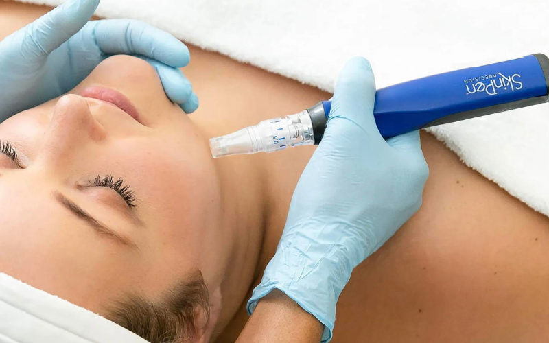 Skinpen microneedling in northern virginia