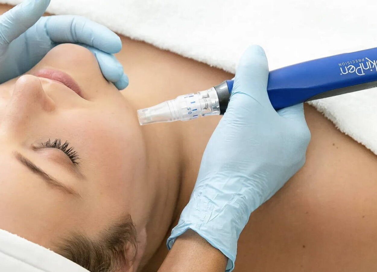 Microneedling with Skin Pen